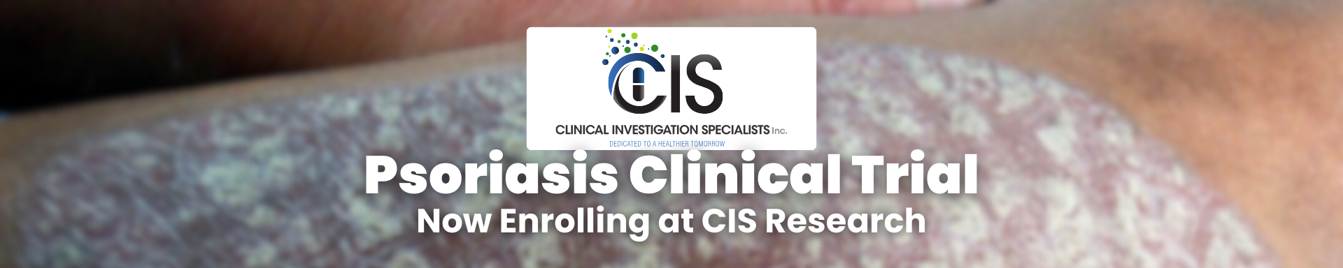 Psoriasis Clinical Trial