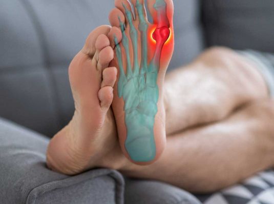 Gout Flare Up in Foot