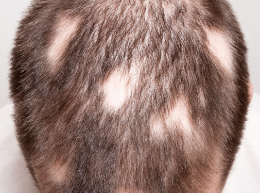 man with alopecia areata bald patches in hair